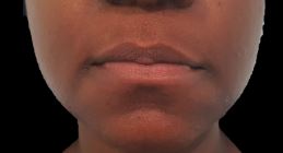 Lip Filler Juvederm Before and After